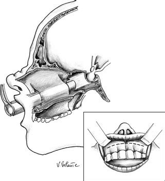 sublabial incision pituitary tumor